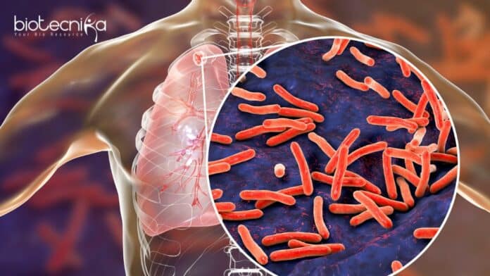 South Africa Launches Gates-Backed Study for Shorter Tuberculosis Drug Regimens